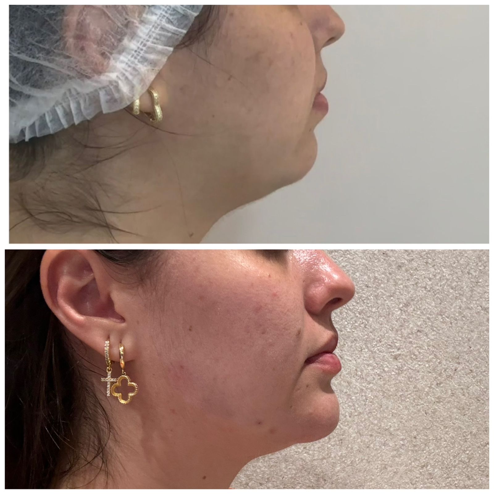 Resultado Antes e Depois